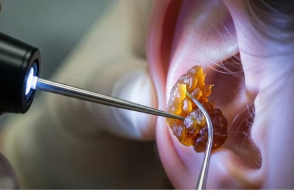 घरी इयरवॅक्स कसे स्वच्छ करावे? इयरवॅक्स पासून मुक्त होण्यासाठी 5 सोप्या ट्रिक्स