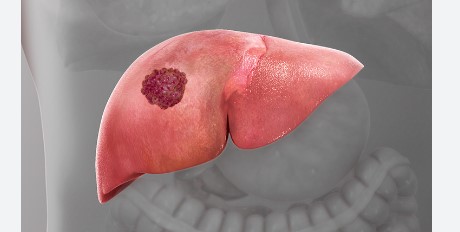 फक्त मद्यपान करणाऱ्यांमध्येच नाहीतर न करणाऱ्यांमध्येही वाढतोय यकृताच्या कर्करोगाचा धोका; जीवनशैलीत आता करा बदल…