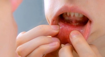 भारतात वाढतोय तोंडाच्या कर्करोगाचा धोका; वेळीच काळजी घेणे बनते गरजेचे…