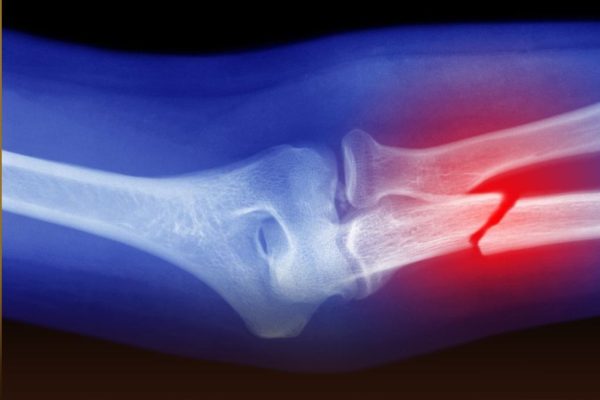Bone Glue: तुटलेली हाडे जोडण्यासाठी चीनने तयार केला अनोखा फेव्हिकॉल