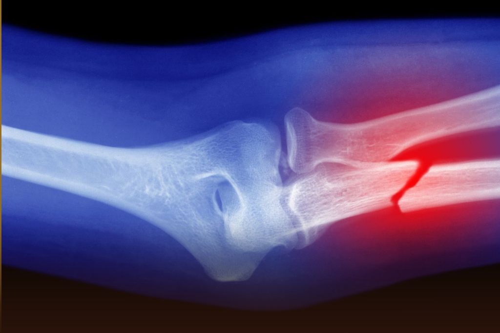 Bone Glue: तुटलेली हाडे जोडण्यासाठी चीनने तयार केला अनोखा फेव्हिकॉल