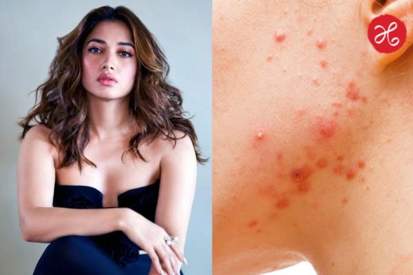 Acne: पिंपल्सपासून सुटका मिळवण्यासाठी तमन्ना भाटियाने सांगितलेला ‘हा’ उपाय खरंच प्रभावी आहे का? जाणून घ्या